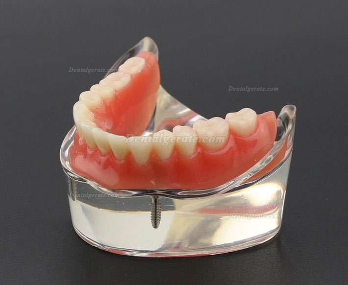Modell f&uuml;r Zahnz&auml;hne &Uuml;berprothese minderwertig bei 2 Implantaten Demo-Modell 6002 01